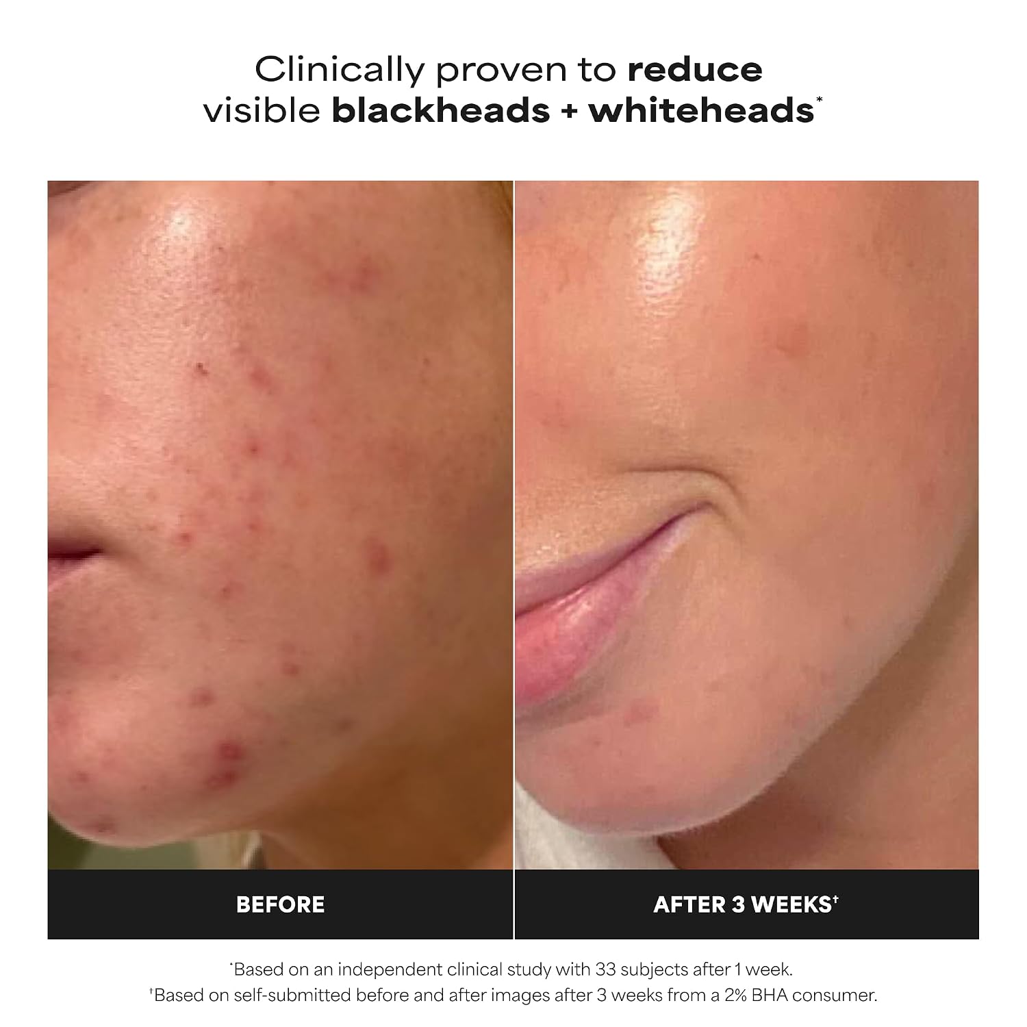 Paula's Choice SKIN PERFECTING 2% BHA Liquid Exfoliant with Salicylic Acid, Facial Polish 